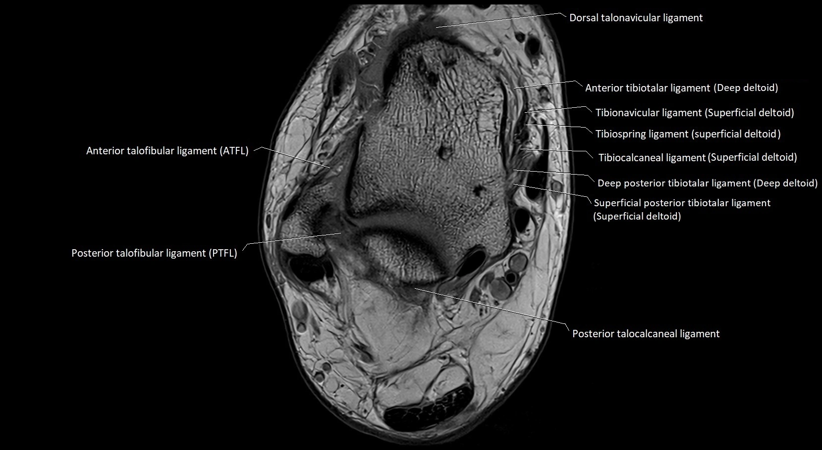 MRI ankle ligaments anatomy axial 3T image 11.webp